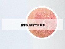 治牛皮癣特效小偏方