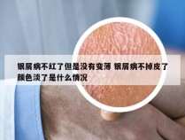 银屑病不红了但是没有变薄 银屑病不掉皮了颜色淡了是什么情况