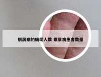 银屑病的确切人数 银屑病患者数量