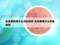 头皮癣的用什么洗比较好 头皮癣用什么药能擦好