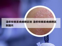 湿疹和银屑病病理区别 湿疹和银屑病病理区别图片