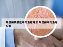 牛皮癣的最佳中药治疗方法 牛皮癣中药治疗配方