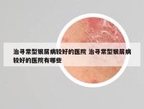 治寻常型银屑病较好的医院 治寻常型银屑病较好的医院有哪些