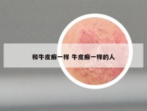 和牛皮癣一样 牛皮癣一样的人
