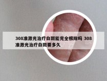 308准激光治疗白斑能完全根除吗 308准激光治疗白斑要多久