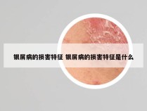 银屑病的损害特征 银屑病的损害特征是什么