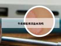 牛皮癣能用淡盐水洗吗