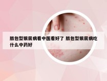 脓包型银屑病看中医看好了 脓包型银屑病吃什么中药好