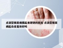 点滴型银屑病摸起来硬硬的脱皮 点滴型银屑病起白皮是快好吗
