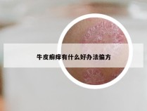 牛皮癣痒有什么好办法偏方