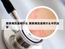 银屑病洗澡用什么 银屑病洗澡用什么中药治胃