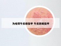 为啥得牛皮癣指甲 牛皮肤癣指甲