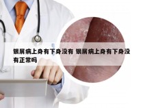 银屑病上身有下身没有 银屑病上身有下身没有正常吗