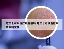 吃三七可以治疗银屑病吗 吃三七可以治疗银屑病吗女性
