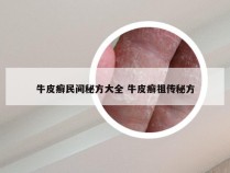 牛皮癣民间秘方大全 牛皮癣祖传秘方