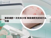 银屑病照一次光多少钱 银屑病照光的叫什么仪器