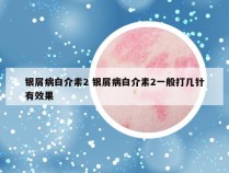 银屑病白介素2 银屑病白介素2一般打几针有效果