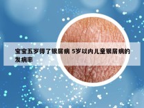 宝宝五岁得了银屑病 5岁以内儿童银屑病的发病率