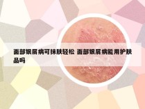 面部银屑病可抹肤轻松 面部银屑病能用护肤品吗