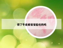 得了牛皮癣宝宝能吃奶吗