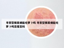 寻常型银屑病能吃萝卜吗 寻常型银屑病能吃萝卜吗百度百科