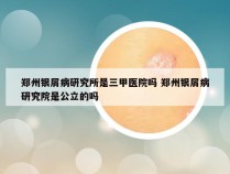 郑州银屑病研究所是三甲医院吗 郑州银屑病研究院是公立的吗