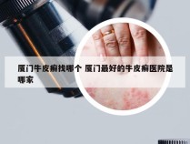 厦门牛皮癣找哪个 厦门最好的牛皮癣医院是哪家