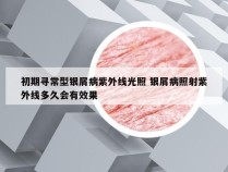 初期寻常型银屑病紫外线光照 银屑病照射紫外线多久会有效果
