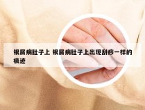 银屑病肚子上 银屑病肚子上出现刮痧一样的痕迹