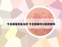 牛皮癣推拿能治好 牛皮肤癣可以做按摩吗