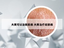 大黄可以治银屑病 大黄治疗皮肤病