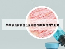 银屑病是肾阴虚还是阳虚 银屑病是因为脏吗