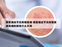 银屑病关节炎和银屑病 银屑病关节炎和银屑病发病机制有什么不同