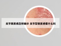 关节银屑病怎样确诊 关节型银屑病看什么科