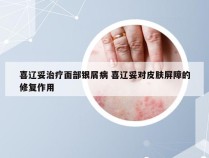 喜辽妥治疗面部银屑病 喜辽妥对皮肤屏障的修复作用