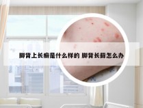 脚背上长癣是什么样的 脚背长藓怎么办