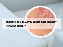 成都有没有治疗头皮银屑病的医院 成都哪个医院治银屑病好?