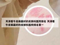 天津看牛皮癣最好的皮肤科医院排名 天津看牛皮癣最好的皮肤科医院排名第一