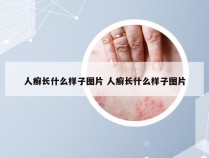 人癣长什么样子图片 人癣长什么样子图片