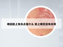 晒后脸上有白点是什么 脸上晒完后有白斑