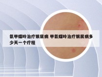 氨甲蝶呤治疗银屑病 甲氨蝶呤治疗银屑病多少天一个疗程