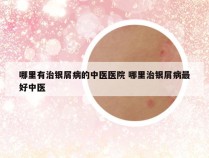 哪里有治银屑病的中医医院 哪里治银屑病最好中医