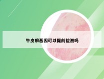 牛皮癣基因可以提前检测吗