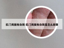 肛门周围有白斑 肛门周围有白斑是怎么回事