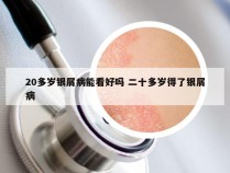 20多岁银屑病能看好吗 二十多岁得了银屑病
