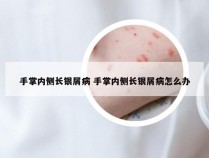 手掌内侧长银屑病 手掌内侧长银屑病怎么办