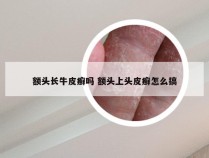 额头长牛皮癣吗 额头上头皮癣怎么搞