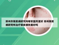 郑州市银屑病研究所哪家医院更好 郑州银屑病研究所治疗银屑病效果好吗