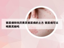 银屑病特效药黄芪银屑病的土方 银屑病可以喝黄芪精吗