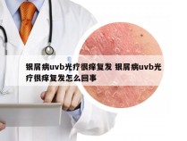 银屑病uvb光疗很痒复发 银屑病uvb光疗很痒复发怎么回事